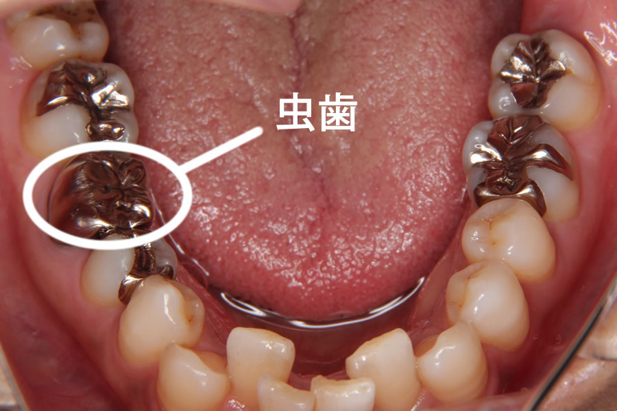 むし歯で歯を失った方 当院の矯正治療 矯正歯科クリニック グレイスデンタル