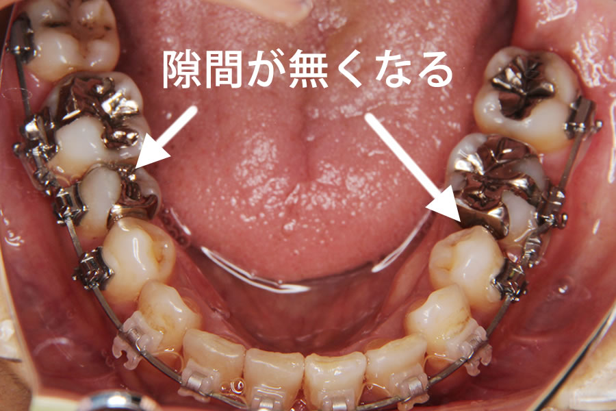 抜歯 奥歯 奥歯の抜歯後、放置するのは危険！？恐ろしい悪影響と、正しい治療法